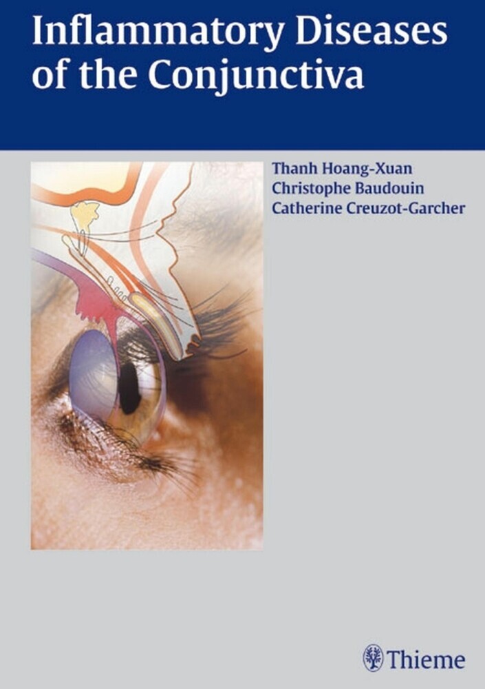 Inflammatory Diseases of the Conjuctiva