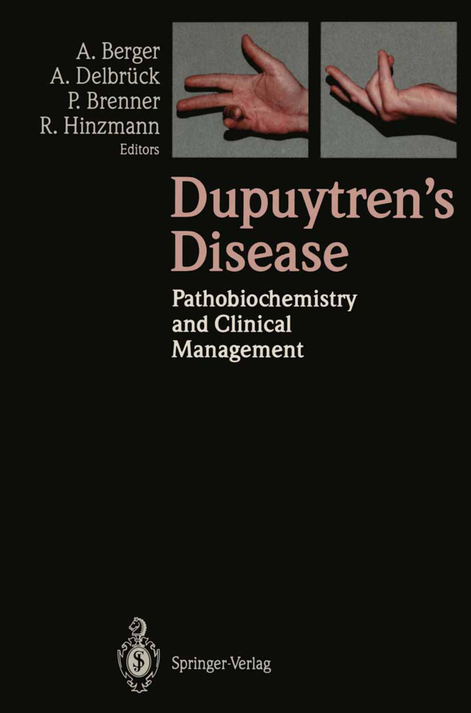 Dupuytren's Disease