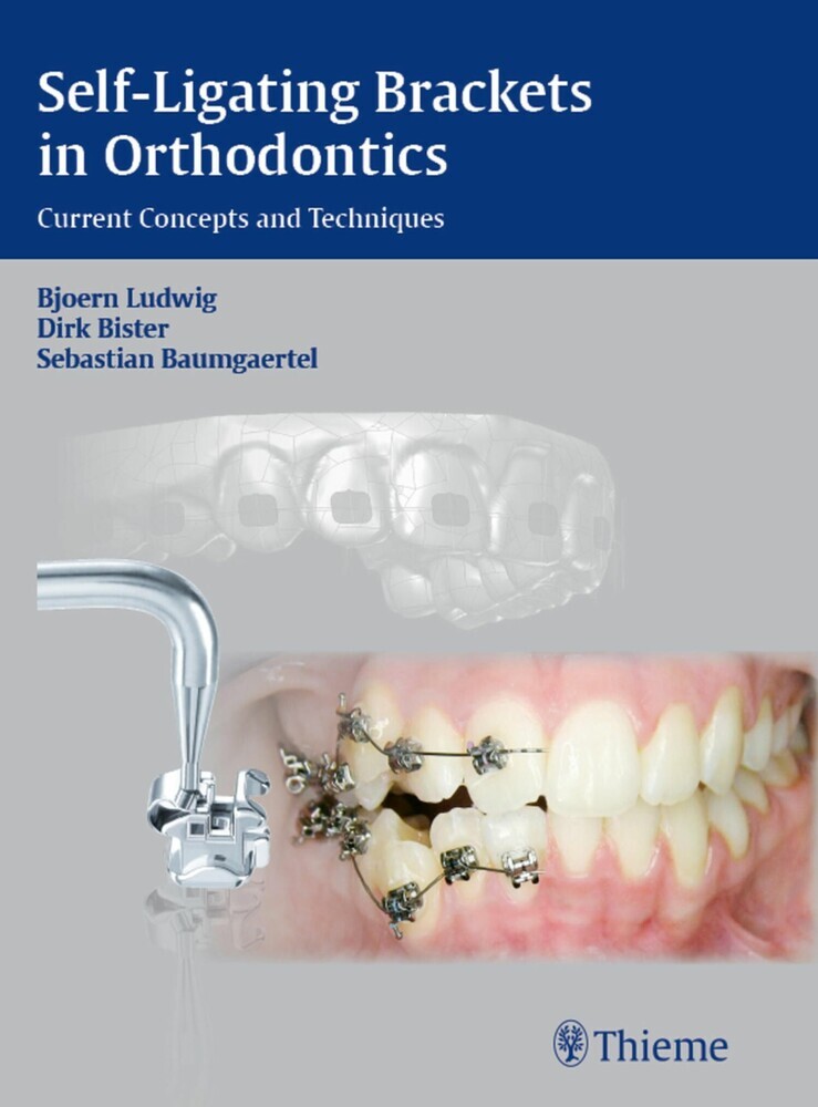 Self-Ligating Brackets in Orthodontics